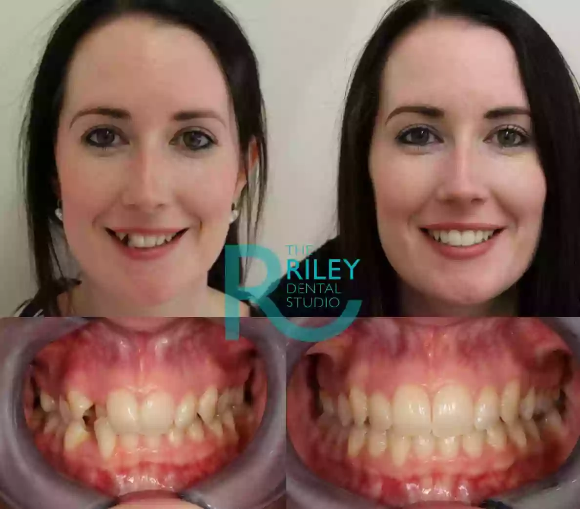 Invisalign Stoke on Trent